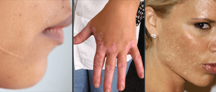 Hypopigmentation examples