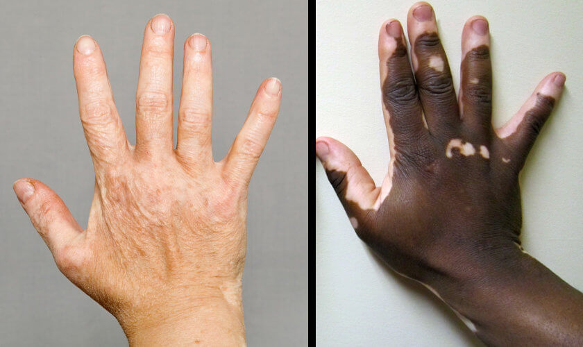 Vitiligo on hands