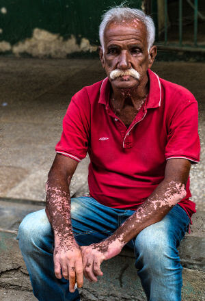 What vitiligo looks like. Image credit: Robert Levy